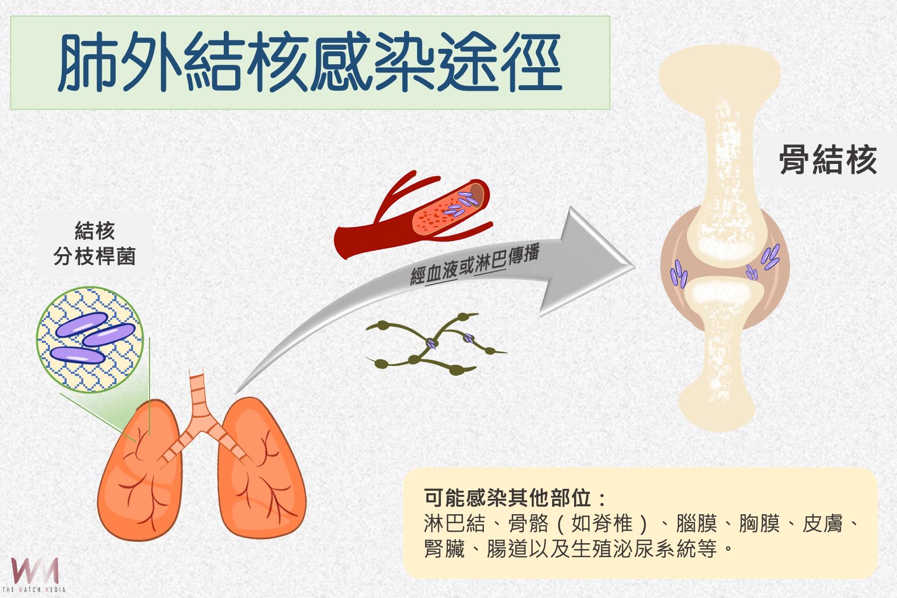 結核菌侵襲膝蓋腫痛難熬　台中慈濟醫院團隊救膝關節　　 - https://www.watchmedia01.com